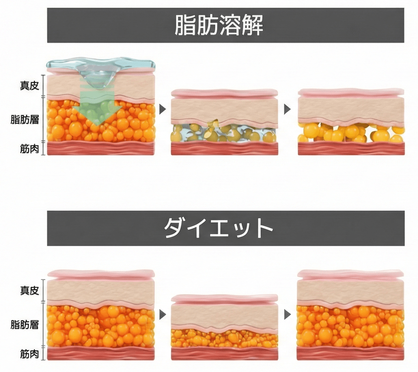 脂肪溶解とダイエットの違いを示す断面図。脂肪溶解は脂肪細胞そのものにアプローチし、ダイエットは細胞の中身のみが変化する。